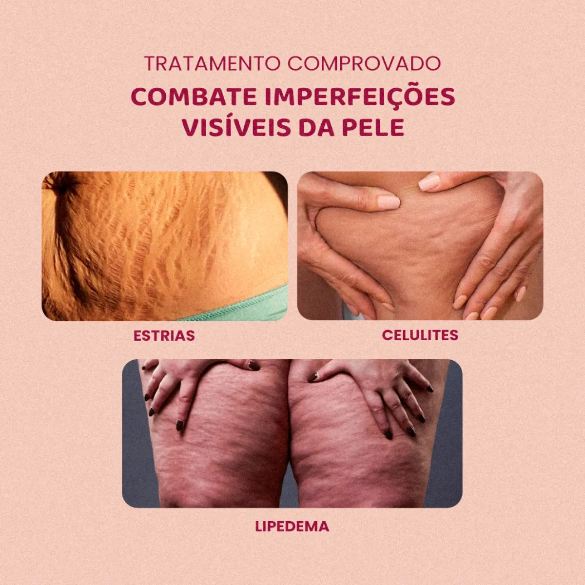 [COMPE 1 LEVE 2] Popozuda Creme Para Lipedema Celulite E Estrias 200g – imagem 4
